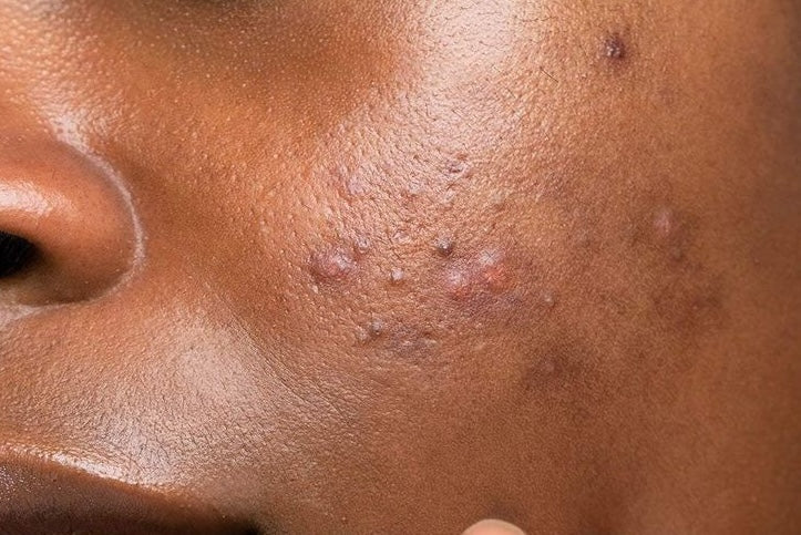 Traiter l'hyperpigmentation peaux noires et métisses